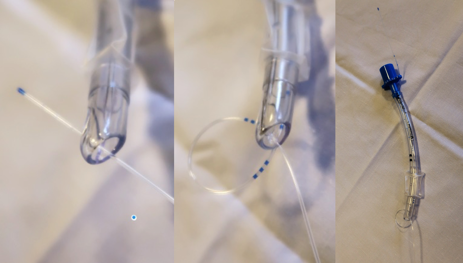 Figure Retrograde intubation3acatheter forms half a knot via murphy eye